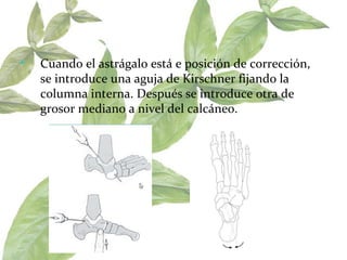 Cuando el astrágalo está e posición de corrección,  se introduce una aguja de Kirschner fijando la columna interna. Después se introduce otra de grosor mediano a nivel del calcáneo.  