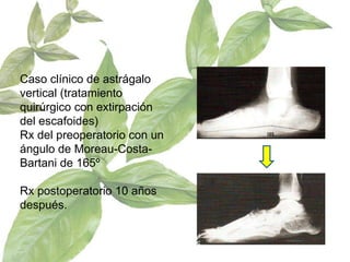 Caso clínico de astrágalo vertical (tratamiento quirúrgico con extirpación del escafoides)  Rx del preoperatorio con un ángulo de Moreau-Costa-Bartani de 165º  Rx postoperatorio 10 años después. 