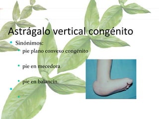 Astrágalo vertical congénito Sinónimos:  pie plano convexo congénito  pie en mecedora  pie en balancín.  