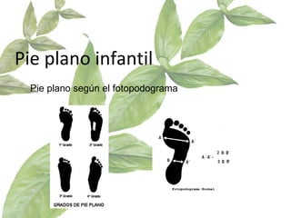 Pie plano infantil Pie plano según el fotopodograma 