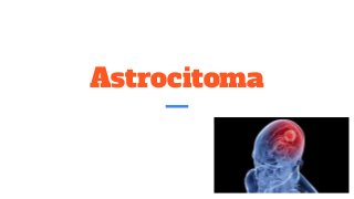 Astrocitoma
 