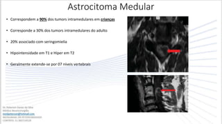 Astrocitoma Medular
• Correspondem a 90% dos tumors intramedulares em crianças
• Corresponde a 30% dos tumors intramedulares do adulto
• 20% associado com seringomielia
• Hipointensidade em T1 e Hiper em T2
• Geralmente extende-se por 07 níveis vertebrais
 