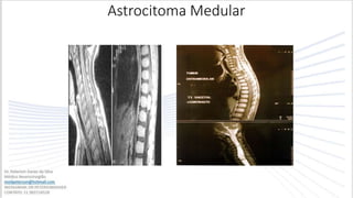 Astrocitoma Medular
 