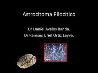 AstrocitomaPilocítico Dr Daniel Avalos Banda.  Dr Ramsés Uriel Ortiz Leyva. 