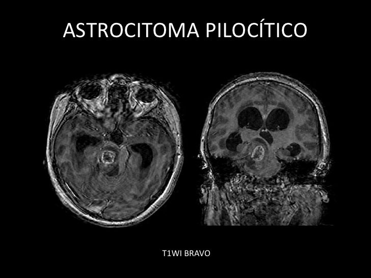 Astrocitoma PilocíTico Definitivo