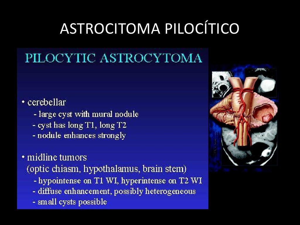 Astrocitoma PilocíTico Definitivo