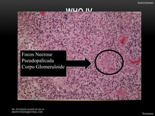 WHO IV
Astrocitomas
Youmans
DR. PETERSON XAVIER DA SILVA
MEDPETERSON@HOTMAIL.COM
Focos Necrose
Pseudopalicada
Corpo Glomeruloide
 