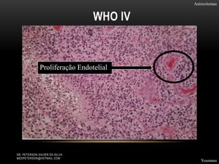 WHO IV
Astrocitomas
Youmans
DR. PETERSON XAVIER DA SILVA
MEDPETERSON@HOTMAIL.COM
Proliferação Endotelial
 