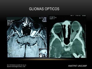 GLIOMAS OPTICOS
DR. PETERSON XAVIER DA SILVA
MEDPETERSON@HOTMAIL.COM ANATPAT UNICAMP
 