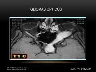 GLIOMAS OPTICOS
DR. PETERSON XAVIER DA SILVA
MEDPETERSON@HOTMAIL.COM ANATPAT UNICAMP
 