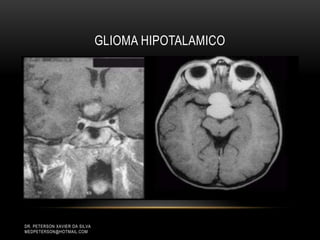 GLIOMA HIPOTALAMICO
DR. PETERSON XAVIER DA SILVA
MEDPETERSON@HOTMAIL.COM
 
