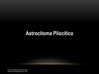 DR. PETERSON XAVIER DA SILVA
MEDPETERSON@HOTMAIL.COM
Astrocitoma Pilocítico
 