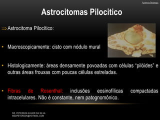 Astrocitoma Pilocítico:
• Macroscopicamente: cisto com nódulo mural
• Histologicamente: áreas densamente povoadas com células “pilóides” e
outras áreas frouxas com poucas células estreladas.
• Fibras de Rosenthal: inclusões eosinofílicas compactadas
intracelulares. Não é constante, nem patognomônico.
Astrocitomas
Astrocitomas Pilocitico
DR. PETERSON XAVIER DA SILVA
MEDPETERSON@HOTMAIL.COM
 
