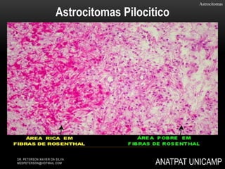 Astrocitomas
Astrocitomas Pilocitico
ANATPAT UNICAMPDR. PETERSON XAVIER DA SILVA
MEDPETERSON@HOTMAIL.COM
 