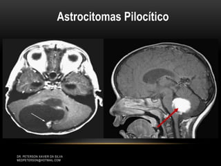 Astrocitomas Pilocítico
DR. PETERSON XAVIER DA SILVA
MEDPETERSON@HOTMAIL.COM
 