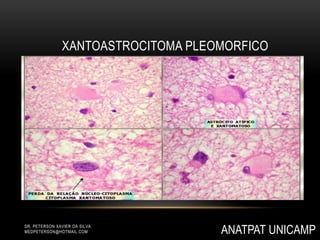 DR. PETERSON XAVIER DA SILVA
MEDPETERSON@HOTMAIL.COM
XANTOASTROCITOMA PLEOMORFICO
ANATPAT UNICAMP
 