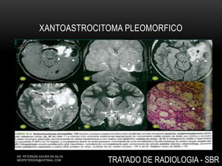 XANTOASTROCITOMA PLEOMORFICO
DR. PETERSON XAVIER DA SILVA
MEDPETERSON@HOTMAIL.COM TRATADO DE RADIOLOGIA - SBR
 