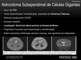 • Grau I da OMS
• Tumor intraventricular. Invariavelmente associado com Esclerose Tuberosa.
• Pacientes adulto jovem (10-20ª)
• Evolução indolente
• Localização: Ventrículo lateral próximo ao forame de Monro
• Prognostico Favorável (rara disseminação e transformação)
• Podem apresentar proliferação vascular e necrose, sem significado de malignidade
Astrocitomas
Astrocitoma Subependimal de Células Gigantes
DR. PETERSON XAVIER DA SILVA
MEDPETERSON@HOTMAIL.COM TRATADO SBN
 