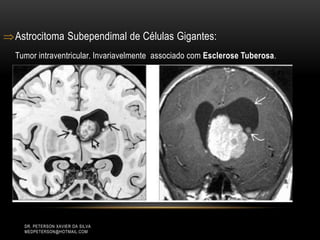 Astrocitoma Subependimal de Células Gigantes:
Tumor intraventricular. Invariavelmente associado com Esclerose Tuberosa.
DR. PETERSON XAVIER DA SILVA
MEDPETERSON@HOTMAIL.COM
 