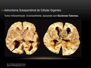 Astrocitoma Subependimal de Células Gigantes:
Tumor intraventricular. Invariavelmente associado com Esclerose Tuberosa.
DR. PETERSON XAVIER DA SILVA
MEDPETERSON@HOTMAIL.COM
 