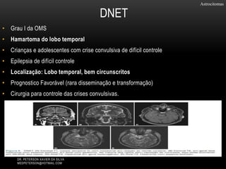 • Grau I da OMS
• Hamartoma do lobo temporal
• Crianças e adolescentes com crise convulsiva de difícil controle
• Epilepsia de difícil controle
• Localização: Lobo temporal, bem circunscritos
• Prognostico Favorável (rara disseminação e transformação)
• Cirurgia para controle das crises convulsivas.
Astrocitomas
DNET
DR. PETERSON XAVIER DA SILVA
MEDPETERSON@HOTMAIL.COM
 
