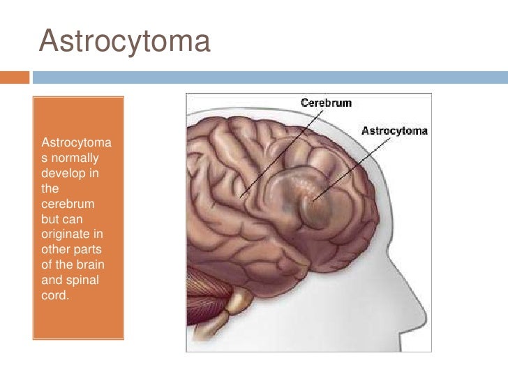 a case study astrocytoma