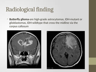 Radiological finding
• Butterfly glioma-are high-grade astrocytomas, IDH-mutant or
glioblastomas, IDH-wildtype that cross the midline via the
corpus callosum
 