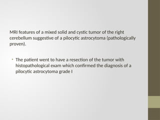 MRI features of a mixed solid and cystic tumor of the right
cerebellum suggestive of a pilocytic astrocytoma (pathologically
proven).
• The patient went to have a resection of the tumor with
histopathological exam which confirmed the diagnosis of a
pilocytic astrocytoma grade I
 