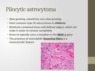 Pilocytic astrocytoma
• Slow growing, sometimes very slow growing
• Most common type Of astrocytoma in childrens
• Relatively contained (have well-defined edges), which can
make it easier to remove completely
• Know to typically carry a mutation in the BRAF-1 gene
• The presence of eosinophilic Rosenthal fibers is a
characteristic feature
 