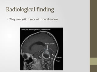 Radiological finding
• They are cystic tumor with mural nodule
 
