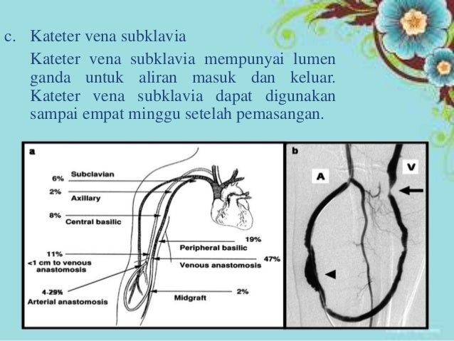 Asuhan keperawatan hemodialisa Asuhan keperawatan hemodialisa