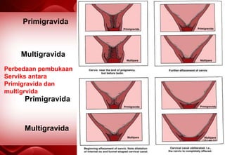 Primigravida
Multigravida
Perbedaan pembukaan
Serviks antara
Primigravida dan
multigrvida
Primigravida
Multigravida
 