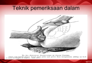 Teknik pemeriksaan dalam
 