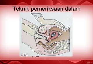 Teknik pemeriksaan dalam
 