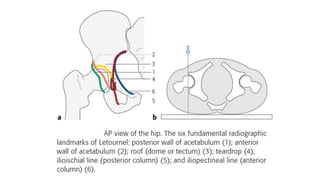 A summary of fractures of acetabulum | PPT