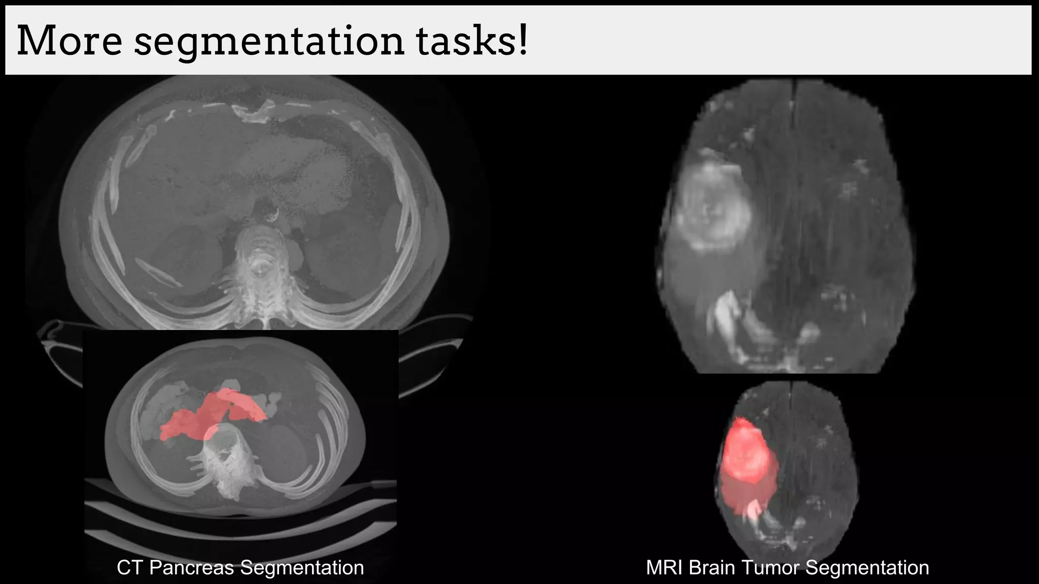 More segmentation tasks!
CT Pancreas Segmentation MRI Brain Tumor Segmentation
 