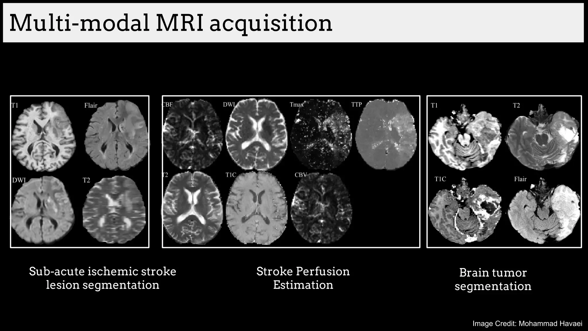 Multi-modal MRI acquisition
T1 T2
T1C Flair
Sub-acute ischemic stroke
lesion segmentation
Stroke Perfusion
Estimation
Brain tumor
segmentation
Image Credit: Mohammad Havaei
 