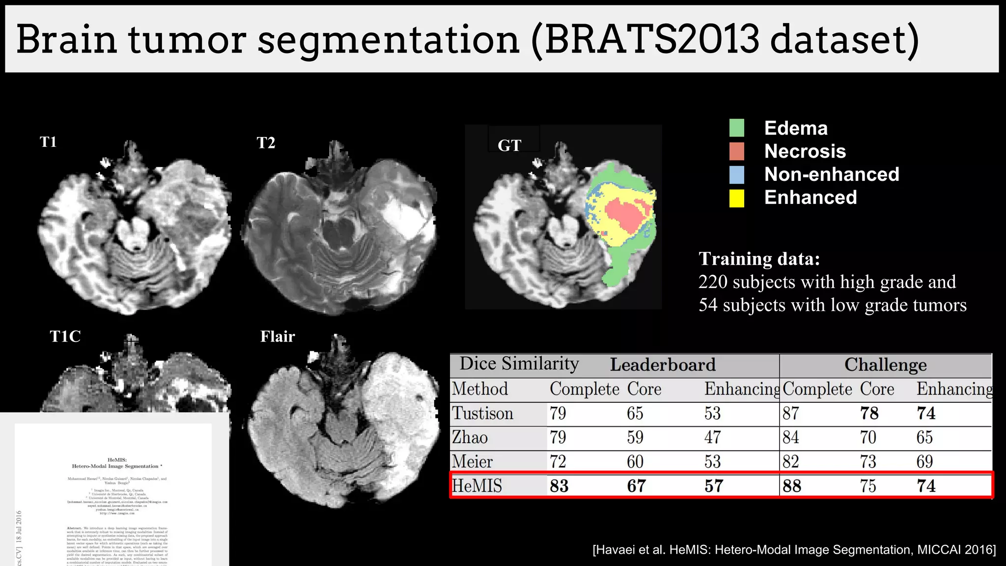 Brain tumor segmentation (BRATS2013 dataset)
T1 T2
T1C Flair
GT
Edema
Necrosis
Non-enhanced
Enhanced
Training data:
220 subjects with high grade and
54 subjects with low grade tumors
Dice Similarity
[Havaei et al. HeMIS: Hetero-Modal Image Segmentation, MICCAI 2016]
 