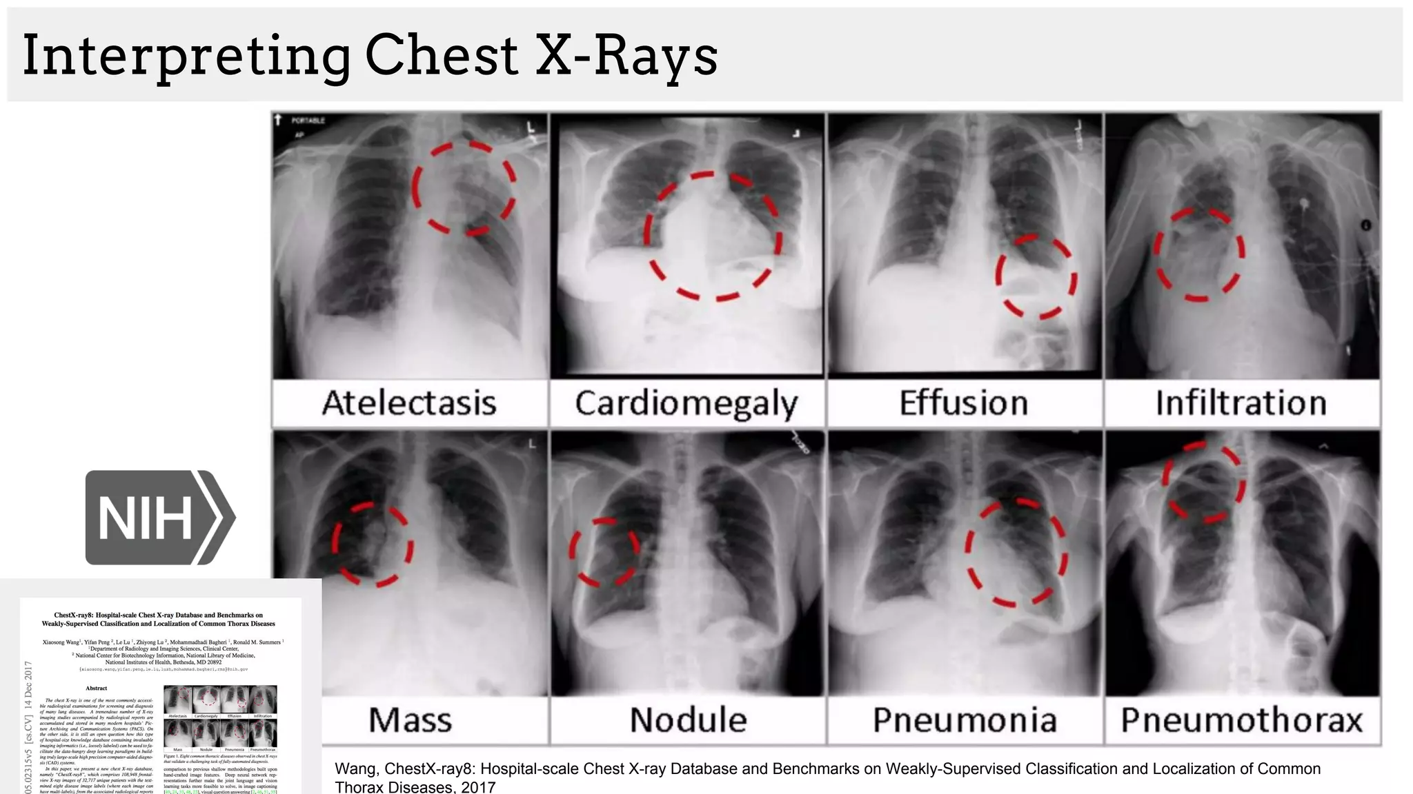 Interpreting Chest X-Rays
Wang, ChestX-ray8: Hospital-scale Chest X-ray Database and Benchmarks on Weakly-Supervised Classification and Localization of Common
Thorax Diseases, 2017
 