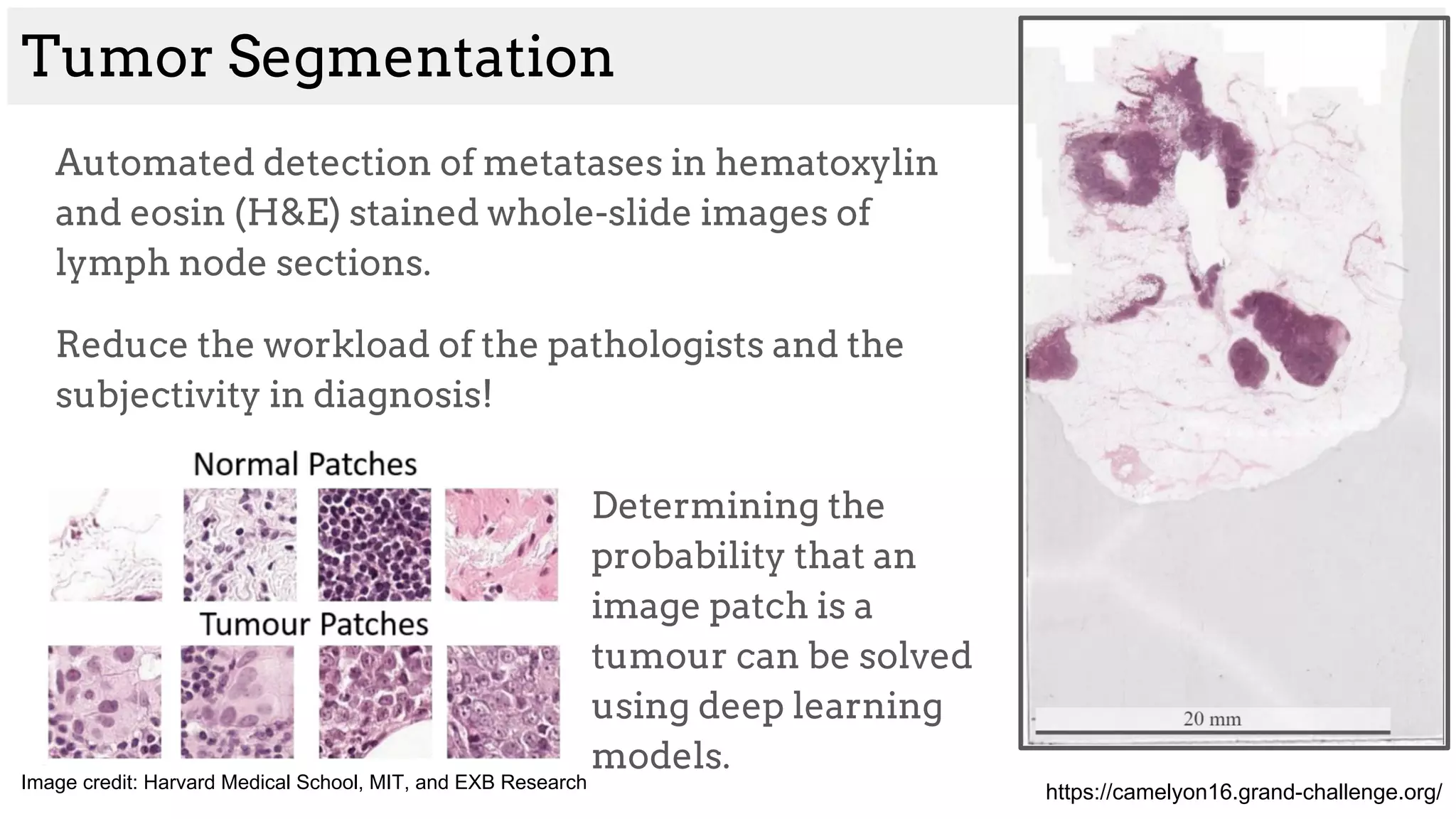 Tumor Segmentation
Automated detection of metatases in hematoxylin
and eosin (H&E) stained whole-slide images of
lymph node sections.
Reduce the workload of the pathologists and the
subjectivity in diagnosis!
https://camelyon16.grand-challenge.org/
Determining the
probability that an
image patch is a
tumour can be solved
using deep learning
models.
Image credit: Harvard Medical School, MIT, and EXB Research
 