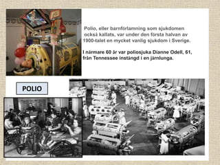 Polio, eller barnförlamning som sjukdomen
också kallats, var under den första halvan av
1900-talet en mycket vanlig sjukdom i Sverige.
I närmare 60 år var poliosjuka Dianne Odell, 61,
från Tennessee instängd i en järnlunga.
POLIO
 