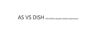 AS VS DISH DISH (Diffuse Idiopathic Skeletal Hyperostosis)
 