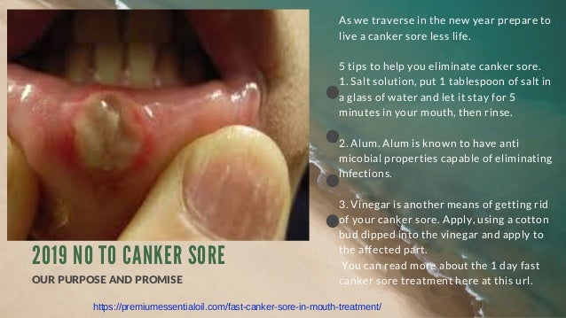 I Day Cure For Canker Sore On Tongue