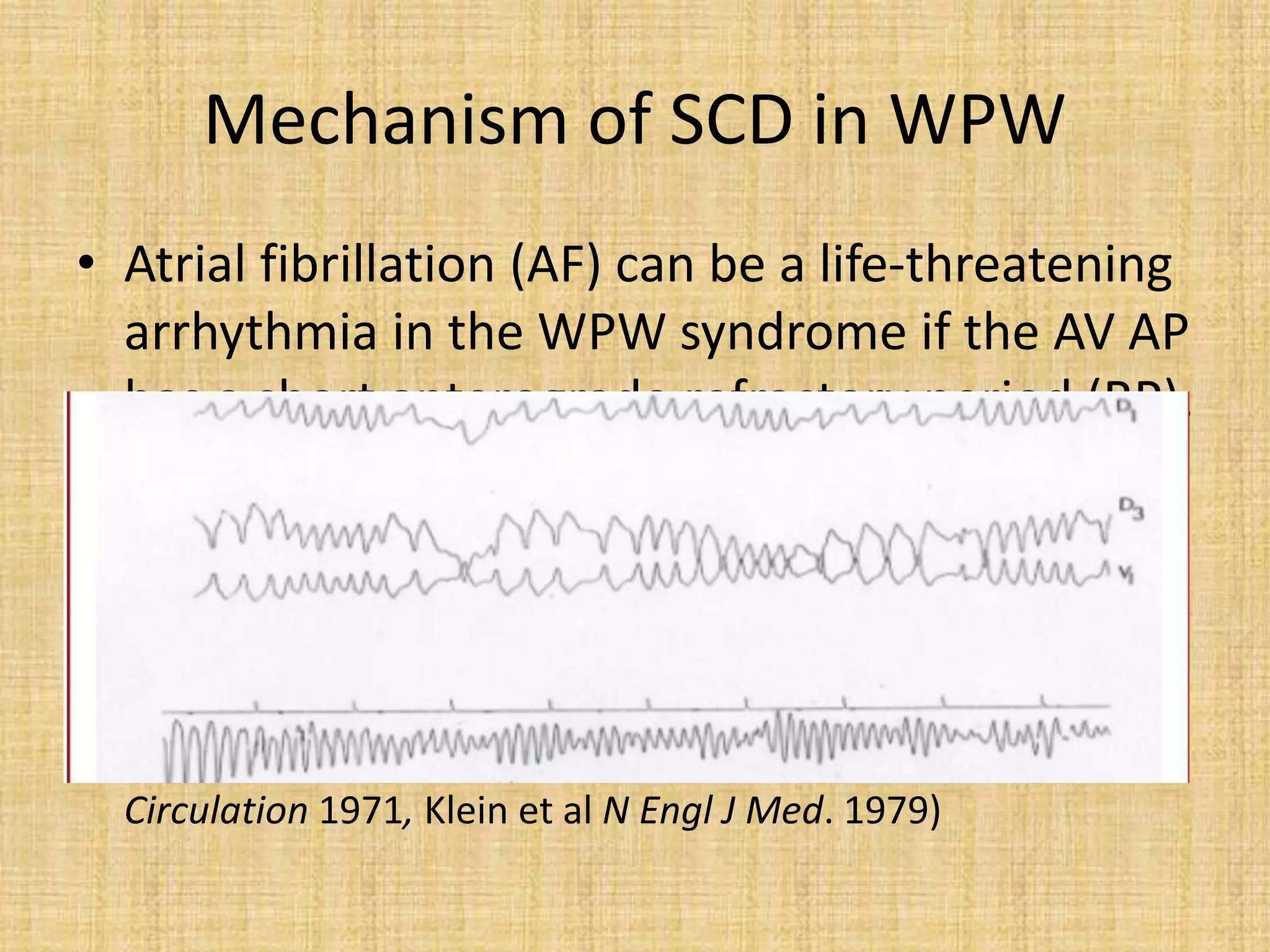 Mechanism of SCD in WPW
• Atrial fibrillation (AF) can be a life-threatening
arrhythmia in the WPW syndrome if the AV AP
has a short anterograde refractory period (RP),
allowing too many atrial impulses to be
conducted to the ventricle.
• This will result in very high ventricular rates
with possible deterioration into ventricular
fibrillation (VF) and sudden death. (Dreyfuset al
Circulation 1971, Klein et al N Engl J Med. 1979)
 