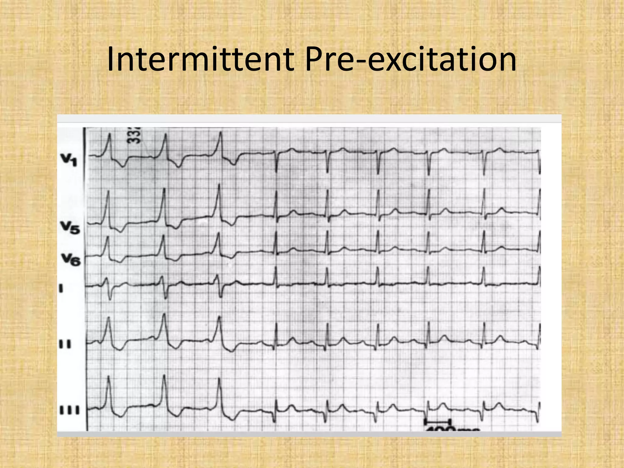 Intermittent Pre-excitation
 