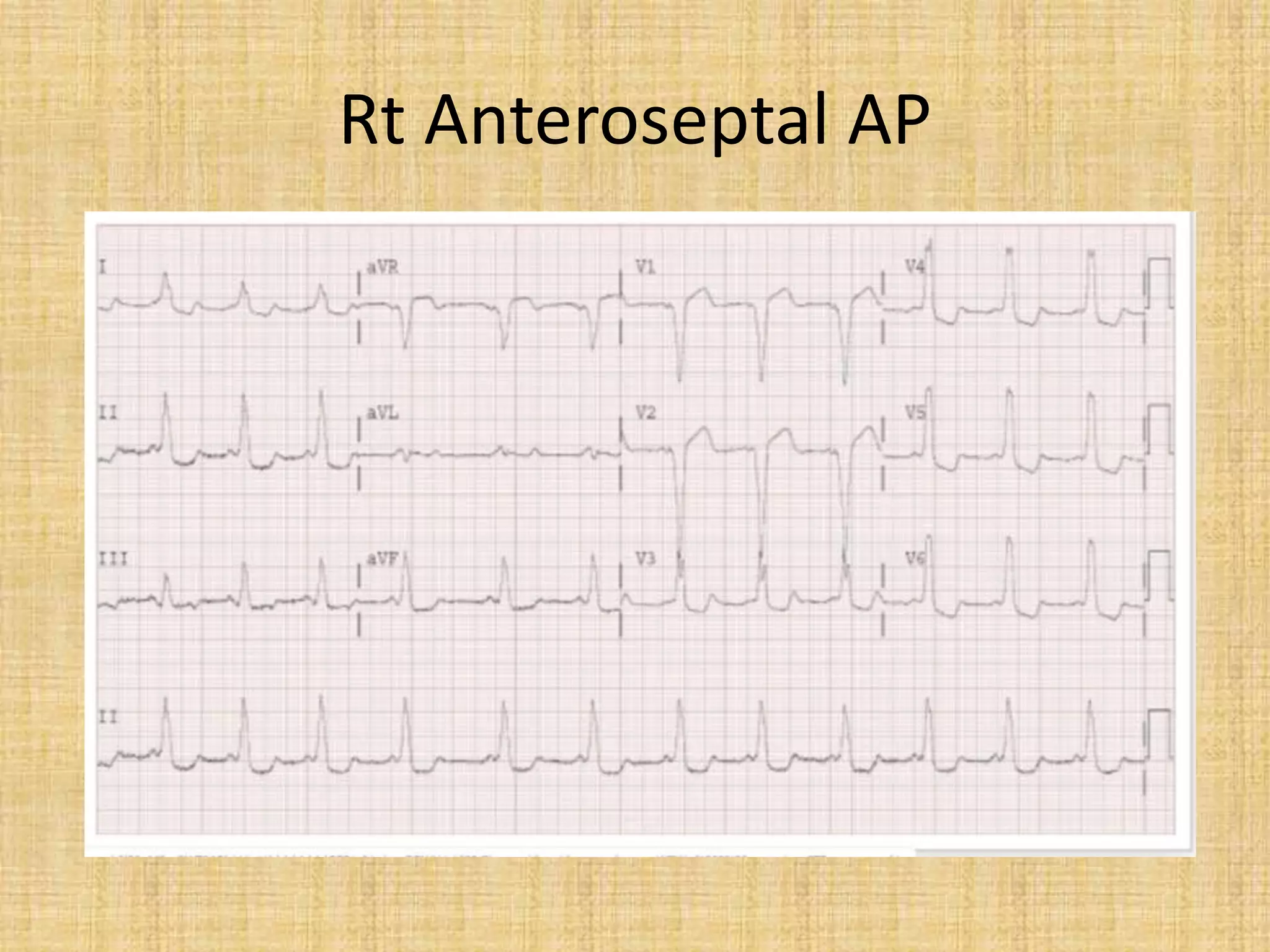 Rt Anteroseptal AP
 