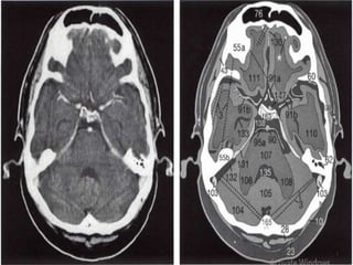Ct Scan Brainline A systematic approach to ct brain | PPTX