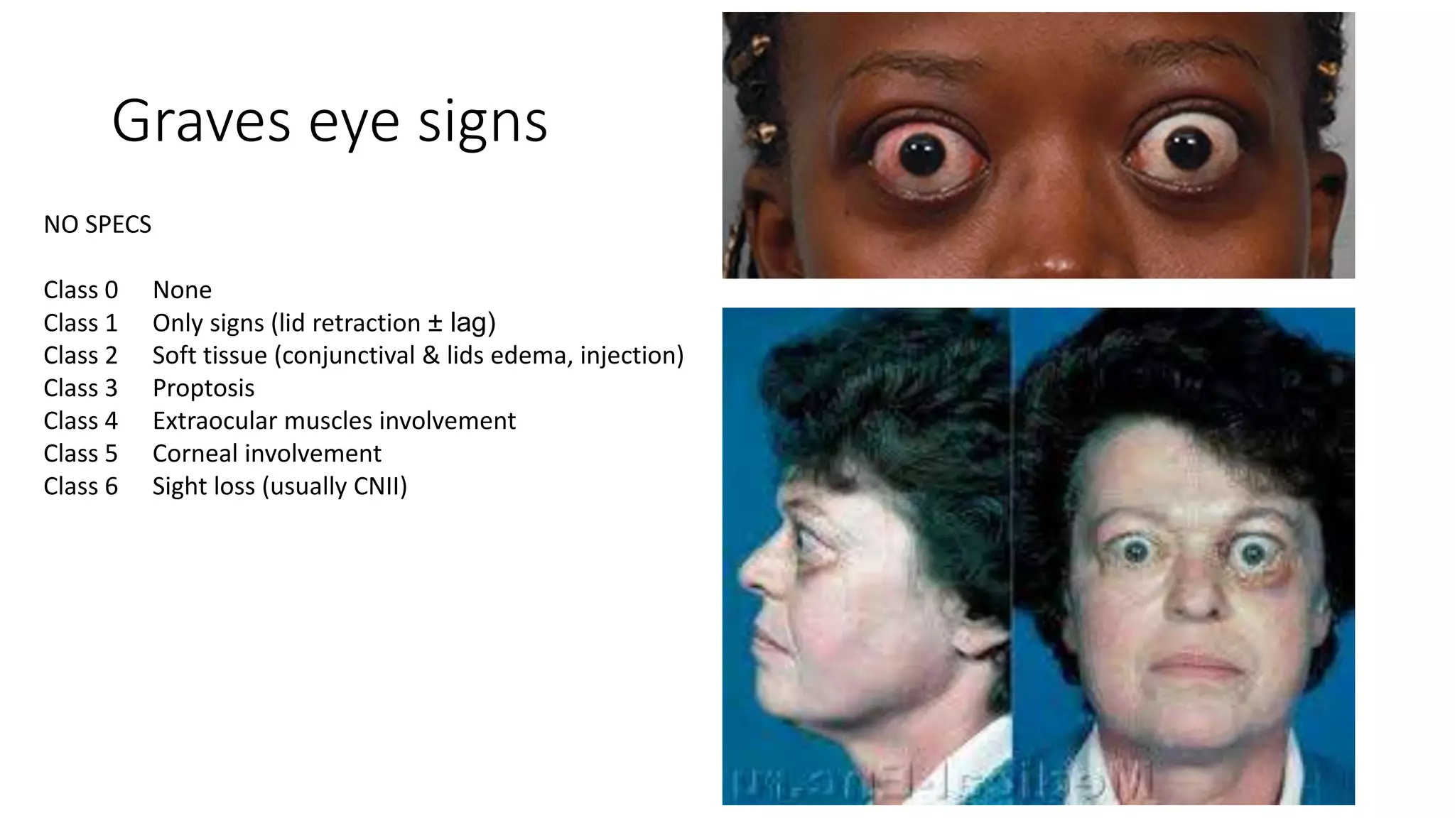 Graves eye signs
NO SPECS
Class 0 None
Class 1 Only signs (lid retraction ± lag)
Class 2 Soft tissue (conjunctival & lids edema, injection)
Class 3 Proptosis
Class 4 Extraocular muscles involvement
Class 5 Corneal involvement
Class 6 Sight loss (usually CNII)
 