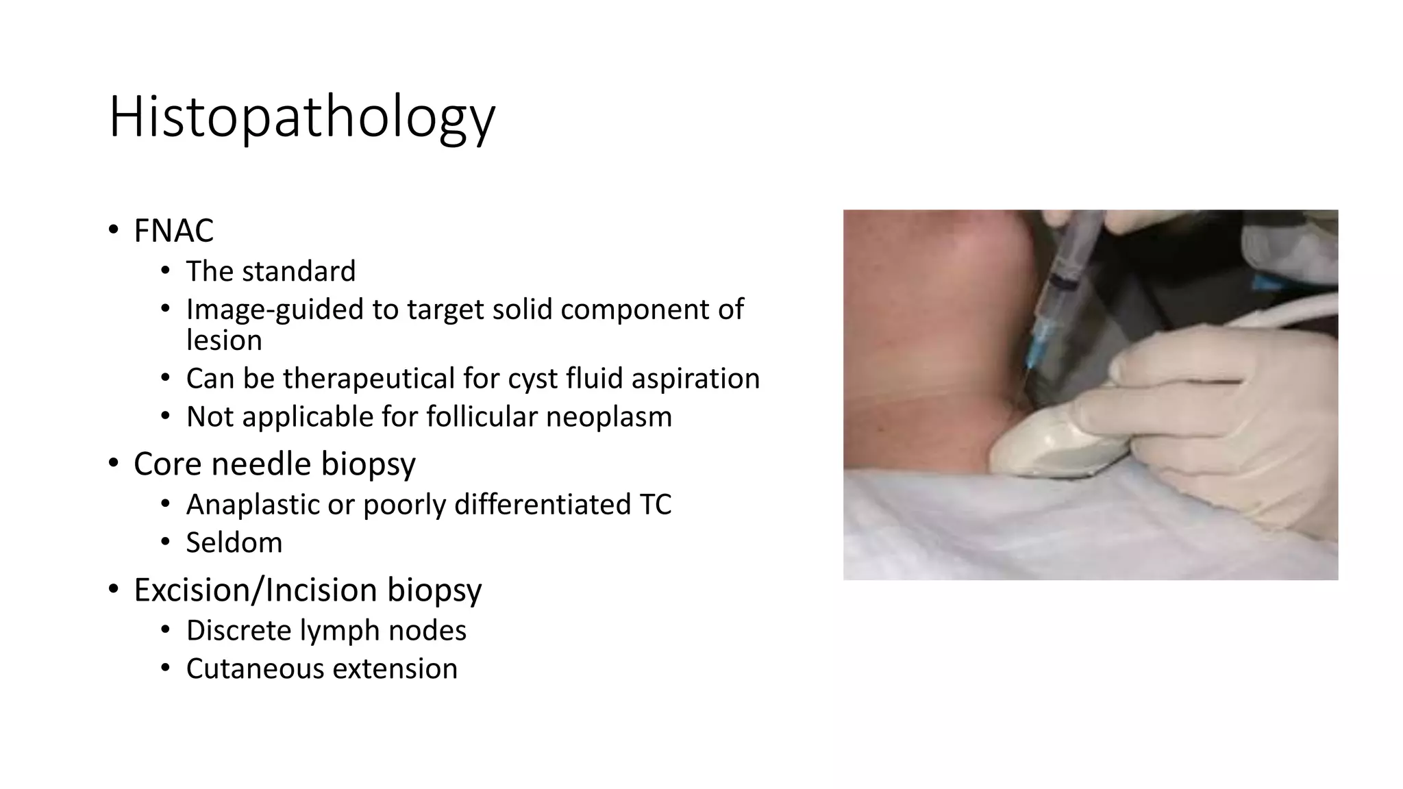 Histopathology
• FNAC
• The standard
• Image-guided to target solid component of
lesion
• Can be therapeutical for cyst fluid aspiration
• Not applicable for follicular neoplasm
• Core needle biopsy
• Anaplastic or poorly differentiated TC
• Seldom
• Excision/Incision biopsy
• Discrete lymph nodes
• Cutaneous extension
 
