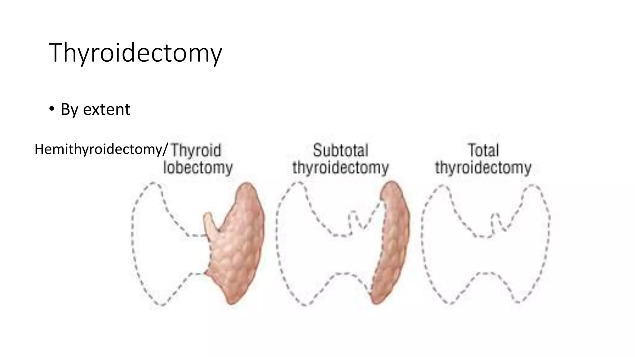 Thyroidectomy
• By extent
Hemithyroidectomy/
 